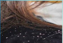 Protect hair from dandruff during the winter season in hindi - Sachi Shiksha