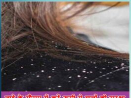 Protect hair from dandruff during the winter season in hindi - Sachi Shiksha