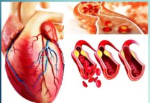 Home Remedies to Treat Heart Blockage in Hindi - Sachi Shiksha