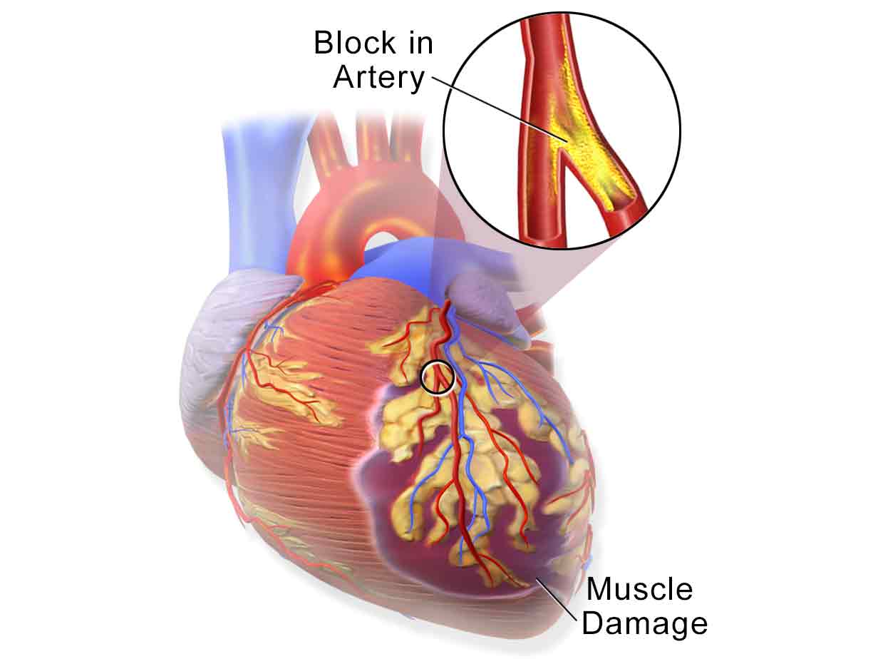 Coronary artery disease - why blockage happens in heart - Sachi Shiksha