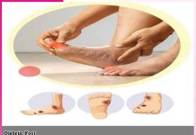 Diabetes Foot: मधुमेह करें बचाव, ताकि न हों पैरों से जुड़ी समस्याएं Diabetes Foot