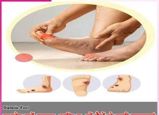 Diabetes Foot: मधुमेह करें बचाव, ताकि न हों पैरों से जुड़ी समस्याएं Diabetes Foot