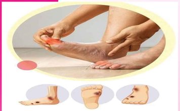 Diabetes Foot