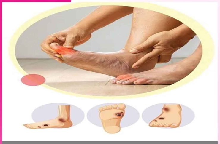 Diabetes Foot: मधुमेह करें बचाव, ताकि न हों पैरों से जुड़ी समस्याएं Diabetes Foot