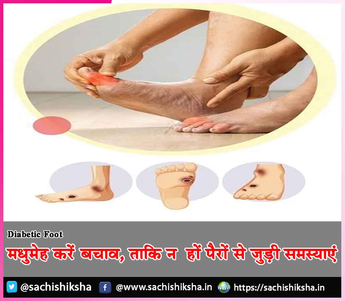 Diabetes Foot Diabetes Foot