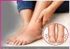 Swelling feet