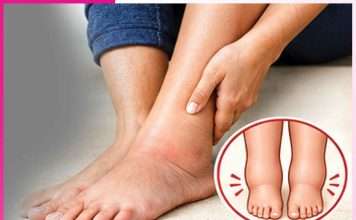 Swelling feet: पैरों की सूजन आराम देंगे प्राकृतिक उपाय Swelling feet