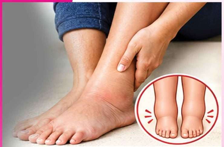 Swelling feet: पैरों की सूजन आराम देंगे प्राकृतिक उपाय Swelling feet